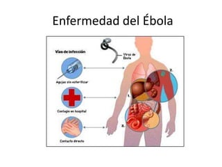 Enfermedad del Ébola
 