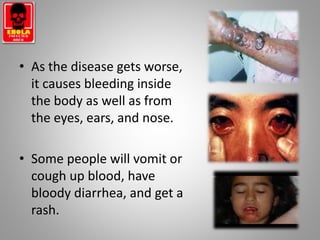 • As the disease gets worse,
it causes bleeding inside
the body as well as from
the eyes, ears, and nose.
• Some people will vomit or
cough up blood, have
bloody diarrhea, and get a
rash.
 