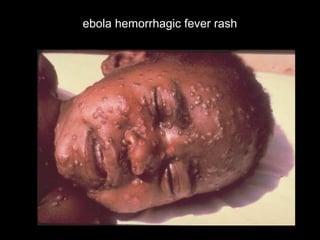 ebola hemorrhagic fever rash
ebola hemorrhagic fever rash