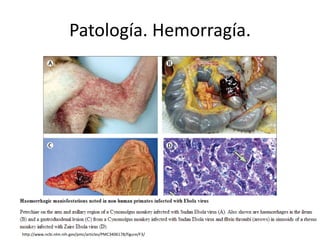 Patología. Hemorragía.
http://www.ncbi.nlm.nih.gov/pmc/articles/PMC3406178/figure/F3/