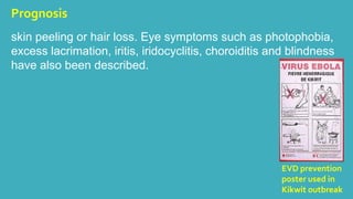 Prognosis 
skin peeling or hair loss. Eye symptoms such as photophobia, 
excess lacrimation, iritis, iridocyclitis, choroiditis and blindness 
have also been described. 
EVD prevention 
poster used in 
Kikwit outbreak 
 