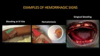 EXAMPLES OF HEMORRHAGIC SIGNS
Bleeding at IV Site Hematemesis
Gingival bleeding
 