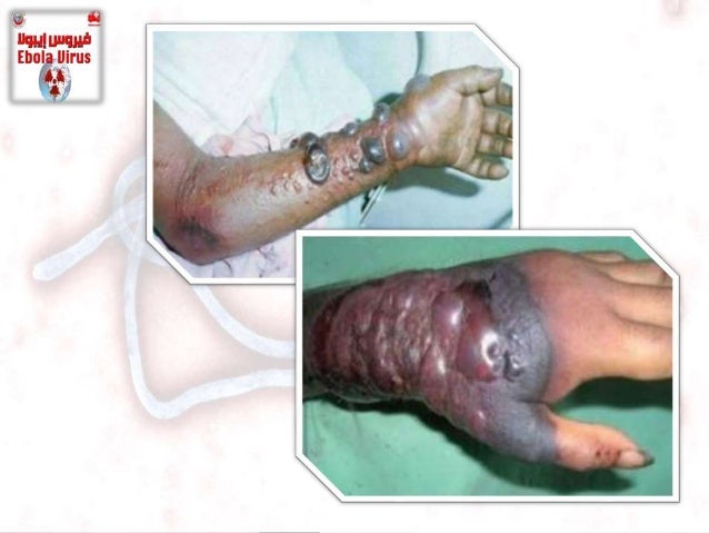 Ebola virus بالعربي