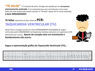 18 www.ibraph.com.br
“TÁ VELOZ” – É o terceiro da prole. Carrega esse apelido por ser uma pessoa
extremamente acelerada. É um empresário que vive correndo para cima e para
baixo, por esse motivo está sempre exausto. O “Tá Veloz” apesar de ser muito acelerado,
é bem ORGANIZADO!
Tá Veloz representa um dos ritmos de PCR:
TAQUICARDIA VENTRICULAR (TV)
Neste ritmo o coração assume um ritmo EXTREMAMENTE ACELERADO de origem
ventricular porém ORGANIZADO. As frequências Cardíaca costumam ser superiores a 250
batimentos por minuto. Apesar do coração estar em movimento o
bombeamento não ocorre.
Segue a representação gráfica da Taquicardia Ventricular (TV)...
2015
 