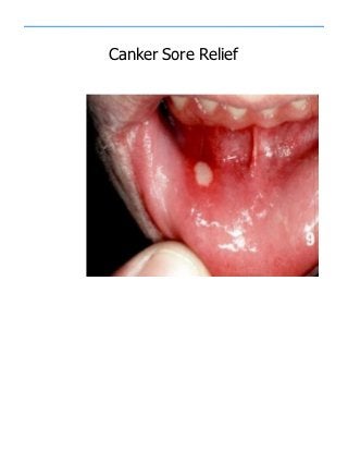 Canker Sore Relief
 