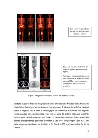   3	
  
Figura 1: Imagens ilustrativas de exames em Medicina Nuclear
Embora a grande maioria dos procedimentos em Medicina Nuclear tenha finalidade
diagnóstica, há alguns procedimentos que possuem finalidade terapêutica. Nestes
casos o objetivo não é mais a investigação de anomalias funcionais nas regiões
metabolizadas pelo radiofármaco, mas sim a ação da própria radiação ionizante
emitida pela radiofármaco em um órgão ou região de interesse. Como exemplos
destes procedimentos podemos destacar o uso dos radioisótopos Iodo-131, em
tratamentos de patologias da tireóide, e do Samário-153 em tratamentos de dores
ósseas.
Esta	
  é	
  uma	
  imagem	
  de	
  um	
  
estudo	
  de	
  captação	
  óssea	
  
de	
  corpo	
  inteiro	
  
Este	
  é	
  um	
  esquema	
  ilustrativo	
  das	
  
imagens	
  obtidas	
  por	
  um	
  sistema	
  
PET/CT.	
  
As	
  imagens	
  indicadas	
  são	
  do	
  estudo	
  
com	
  o	
  sistema	
  CT,	
  do	
  estudo	
  com	
  o	
  
sistema	
  PET	
  e	
  a	
  terceira	
  imagem	
  
compreende	
  a	
  fusão	
  das	
  duas	
  
primeiras.	
  
 
