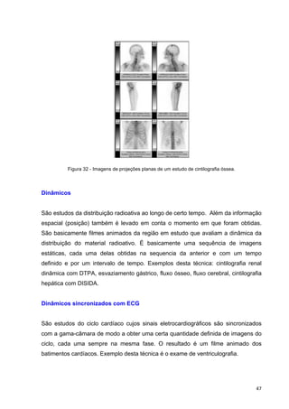   47	
  
Figura 32 - Imagens de projeções planas de um estudo de cintilografia óssea.
Dinâmicos
São estudos da distribuição radioativa ao longo de certo tempo. Além da informação
espacial (posição) também é levado em conta o momento em que foram obtidas.
São basicamente filmes animados da região em estudo que avaliam a dinâmica da
distribuição do material radioativo. É basicamente uma sequência de imagens
estáticas, cada uma delas obtidas na sequencia da anterior e com um tempo
definido e por um intervalo de tempo. Exemplos desta técnica: cintilografia renal
dinâmica com DTPA, esvaziamento gástrico, fluxo ósseo, fluxo cerebral, cintilografia
hepática com DISIDA.
Dinâmicos sincronizados com ECG
São estudos do ciclo cardíaco cujos sinais eletrocardiográficos são sincronizados
com a gama-câmara de modo a obter uma certa quantidade definida de imagens do
ciclo, cada uma sempre na mesma fase. O resultado é um filme animado dos
batimentos cardíacos. Exemplo desta técnica é o exame de ventriculografia.
 