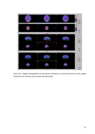   51	
  
Figura 34 - Imagens tomográficas nos três planos: transversal ou axial (duas linha de cima), sagital
(duas linhas no centro) e coronal (duas linhas de baixo).
 