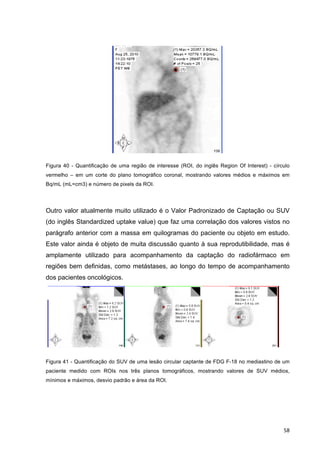   58	
  
Figura 40 - Quantificação de uma região de interesse (ROI, do inglês Region Of Interest) - círculo
vermelho – em um corte do plano tomográfico coronal, mostrando valores médios e máximos em
Bq/mL (mL=cm3) e número de pixels da ROI.
Outro valor atualmente muito utilizado é o Valor Padronizado de Captação ou SUV
(do inglês Standardized uptake value) que faz uma correlação dos valores vistos no
parágrafo anterior com a massa em quilogramas do paciente ou objeto em estudo.
Este valor ainda é objeto de muita discussão quanto à sua reprodutibilidade, mas é
amplamente utilizado para acompanhamento da captação do radiofármaco em
regiões bem definidas, como metástases, ao longo do tempo de acompanhamento
dos pacientes oncológicos.pacientes	
  oncológicos.	
  
	
  
	
  Figura 41 - Quantificação do SUV de uma lesão circular captante de FDG F-18 no mediastino de um
paciente medido com ROIs nos três planos tomográficos, mostrando valores de SUV médios,
mínimos e máximos, desvio padrão e área da ROI.
 
