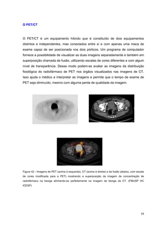   59	
  
O PET/CT
O PET/CT é um equipamento híbrido que é constituído de dois equipamentos
distintos e independentes, mas conectados entre si e com apenas uma maca de
exame capaz de ser posicionada nos dois pórticos. Um programa de computador
fornece a possibilidade de visualizar as duas imagens separadamente e também em
superposição chamada de fusão, utilizando escalas de cores diferentes e com algum
nível de transparência. Desse modo podem-se avaliar as imagens da distribuição
fisiológica do radiofármaco de PET nos órgãos visualizados nas imagens de CT.
Isso ajuda o médico a interpretar as imagens e permite que o tempo de exame de
PET seja diminuído, mesmo com alguma perda de qualidade da imagem.
Figura 42 - Imagens de PET (acima à esquerda), CT (acima à direita) e da fusão (abaixo, com escala
de cores modificada para a PET) mostrando a superposição da imagem de concentração de
radiofármaco na bexiga alinhando-se perfeitamente na imagem de bexiga da CT. (FMUSP HC
ICESP)
 