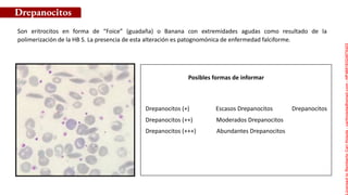 Posibles formas de informar
Son eritrocitos en forma de “Foice” (guadaña) o Banana con extremidades agudas como resultado de la
polimerización de la HB S. La presencia de esta alteración es patognomónica de enfermedad falciforme.
Drepanocitos
Drepanocitos (+) Escasos Drepanocitos Drepanocitos
Drepanocitos (++) Moderados Drepanocitos
Drepanocitos (+++) Abundantes Drepanocitos
Licensed
to
Remberto
Cari
Hojeda
-
carihojeda@gmail.com
-
HP46816324875423
 