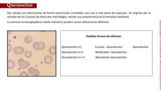 Posibles formas de informar
Son células con alteraciones de forma semicircular (mordida), con una o más pares de espículas. Se originan por la
retirada de los Cuerpos de Heinz por macrófagos, siendo una característica de la hemolisis oxidativa.
La anemia microangiopática o daño mecánico pueden causar alteraciones idénticas.
Queratocitos
Queratocitos (+) Escasos Queratocitos Queratocitos
Queratocitos (++) Moderados Queratocitos
Queratocitos (+++) Abundantes Queratocitos
Licensed
to
Remberto
Cari
Hojeda
-
carihojeda@gmail.com
-
HP46816324875423
 