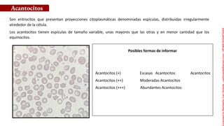 Posibles formas de informar
Son eritrocitos que presentan proyecciones citoplasmáticas denominadas espículas, distribuidas irregularmente
alrededor de la célula.
Los acantocitos tienen espículas de tamaño variable, unas mayores que las otras y en menor cantidad que los
equinocitos.
Acantocitos
Acantocitos (+) Escasas Acantocitos Acantocitos
Acantocitos (++) Moderadas Acantocitos
Acantocitos (+++) Abundantes Acantocitos
Licensed
to
Remberto
Cari
Hojeda
-
carihojeda@gmail.com
-
HP46816324875423
 