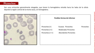 Posibles formas de informar
Son unos eritrocitos generalmente alargados, que tienen la hemoglobina retraída hacia los lados de la célula
dejando la región central de la misma vacía, sin hemoglobina.
Picnocitos (+) Escasos Picnocitos Picnocitos
Picnocitos (++) Moderados Picnocitos
Picnocitos (+++) Abundantes Picnocitos
Picnocitos
Licensed
to
Remberto
Cari
Hojeda
-
carihojeda@gmail.com
-
HP46816324875423
 