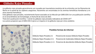 Posibles formas de informar
Glóbulos Rojos Pinzados
Los glóbulos rojos pinzados generalmente son causados por traumatismo mecánico de los eritrocitos con los filamentos de
fibrina en la pared de los capilares sanguíneos. Raramente son encontrados en las anemias hemolíticas hereditarias y en
otras anemias hemolíticas.
Estos glóbulos rojos pinzados, recientemente fueron asociados en la infección por SARS-COV-2 en una publicación científica
en el Jornal Británico de hematología, en fecha 05 de enero de 2021.
Título de la publicación Científica: “¿Serán los glóbulos rojos pinzados indicadores de COVID-19?”.
Los autores proponen que el SARS-COV-2 ejerce un impacto en los glóbulos rojos por stress oxidativo.
Glóbulos Rojos Pinzados (+) Presencia de escasos Glóbulos Rojos Pinzados
Glóbulos Rojos Pinzados (++) Presencia de moderados Glóbulos Rojos Pinzados
Glóbulos Rojos Pinzados (+++) Presencia de abundantes Glóbulos Rojos Pinzados
Licensed
to
Remberto
Cari
Hojeda
-
carihojeda@gmail.com
-
HP46816324875423
 