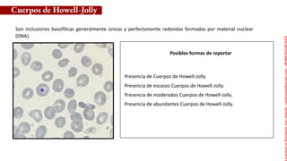 Posibles formas de reportar
Son inclusiones basofílicas generalmente únicas y perfectamente redondas formadas por material nuclear
(DNA).
Cuerpos de Howell-Jolly
Presencia de Cuerpos de Howell-Jolly.
Presencia de escasos Cuerpos de Howell-Jolly.
Presencia de moderados Cuerpos de Howell-Jolly.
Presencia de abundantes Cuerpos de Howell-Jolly.
Licensed
to
Remberto
Cari
Hojeda
-
carihojeda@gmail.com
-
HP46816324875423
 