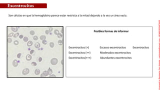 Posibles formas de informar
Son células en que la hemoglobina parece estar restricta a la mitad dejando a la vez un área vacía.
Excentrocitos
Excentrocitos (+) Escasos excentrocitos Excentrocitos
Excentrocitos (++) Moderados excentrocitos
Excentrocitos(+++) Abundantes excentrocitos
Licensed
to
Remberto
Cari
Hojeda
-
carihojeda@gmail.com
-
HP46816324875423
 
