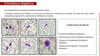Posibles formas de informar
Son eritroblastos que presentan señales de displasia celular.
La displasia celular ocurre debido a un proceso de maduración anormal de las células, de modo que estas células
producidas escapan de las características morfológicas normales.
Eritroblastos displásicos
Presencia Eritroblastos displásicos.
Presencia de escasos Eritroblastos displásicos.
Presencia de moderados Eritroblastos
displásicos.
Presencia de abundantes Eritroblastos
displásicos.
Licensed
to
Remberto
Cari
Hojeda
-
carihojeda@gmail.com
-
HP46816324875423
 