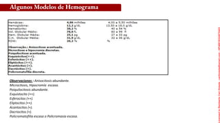 Observaciones : Anisocitosis abundante.
Microcitosis, Hipocromía escasa.
Poiquilocitosis abundante.
Esquistocito (++).
Esferocitos (++).
Eliptocitos (++).
Acantocitos (+).
Dacriocitos (+).
Policromatofilia escasa o Policromasia escasa.
Algunos Modelos de Hemograma
Licensed
to
Remberto
Cari
Hojeda
-
carihojeda@gmail.com
-
HP46816324875423
 
