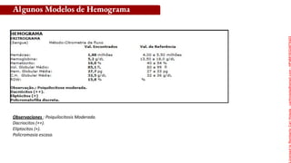 Algunos Modelos de Hemograma
Observaciones : Poiquilocitosis Moderada.
Dacriocitos (++).
Eliptocitos (+).
Policromasia escasa.
Licensed
to
Remberto
Cari
Hojeda
-
carihojeda@gmail.com
-
HP46816324875423
 