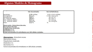 Algunos Modelos de Hemograma
Observaciones : Anisocitosis escasa.
Macrocitosis escasa .
Poiquilocitosis moderada.
Ovalocitos (++).
Dacriocitos (++).
Fueron encontrados 02 eritroblastos en 100 células contadas.
Licensed
to
Remberto
Cari
Hojeda
-
carihojeda@gmail.com
-
HP46816324875423
 