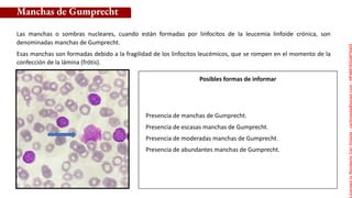 Posibles formas de informar
Las manchas o sombras nucleares, cuando están formadas por linfocitos de la leucemia linfoide crónica, son
denominadas manchas de Gumprecht.
Esas manchas son formadas debido a la fragilidad de los linfocitos leucémicos, que se rompen en el momento de la
confección de la lámina (frótis).
Manchas de Gumprecht
Presencia de manchas de Gumprecht.
Presencia de escasas manchas de Gumprecht.
Presencia de moderadas manchas de Gumprecht.
Presencia de abundantes manchas de Gumprecht.
Licensed
to
Remberto
Cari
Hojeda
-
carihojeda@gmail.com
-
HP46816324875423
 