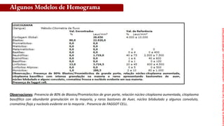 Observaciones: Presencia de 80% de Blastos/Promielocitos de gran porte, relación núcleo citoplasma aumentada, citoplasma
basofílico con abundante granulación en la mayoría, y raros bastones de Auer, núcleo bilobulado y algunos convoluto,
cromatina floja y nucleolo evidente en la mayoría . Presencia de FAGGOT CELL.
Algunos Modelos de Hemograma
Licensed
to
Remberto
Cari
Hojeda
-
carihojeda@gmail.com
-
HP46816324875423
 