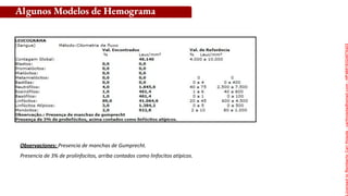 Observaciones: Presencia de manchas de Gumprecht.
Presencia de 3% de prolinfocitos, arriba contados como linfocitos atípicos.
Algunos Modelos de Hemograma
Licensed
to
Remberto
Cari
Hojeda
-
carihojeda@gmail.com
-
HP46816324875423
 