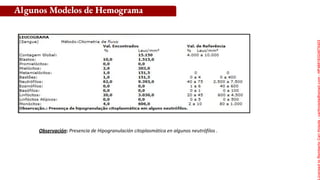 Observación: Presencia de Hipogranulación citoplasmática en algunos neutrófilos .
Algunos Modelos de Hemograma
Licensed
to
Remberto
Cari
Hojeda
-
carihojeda@gmail.com
-
HP46816324875423
 