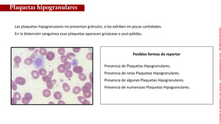 Posibles formas de reportar
Presencia de Plaquetas Hipogranulares.
Presencia de raras Plaquetas Hipogranulares.
Presencia de algunas Plaquetas Hipogranulares.
Presencia de numerosas Plaquetas Hipogranulares.
Las plaquetas hipogranulares no presentan gránulos, o las exhiben en pocas cantidades.
En la distensión sanguínea esas plaquetas aparecen grisáceas o azul-pálidas.
Plaquetas hipogranulares
Licensed
to
Remberto
Cari
Hojeda
-
carihojeda@gmail.com
-
HP46816324875423
 