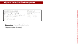 Observaciones: Presencia de macroplaquetas.
Presencia de plaquetas gigantes.
Algunos Modelos de Hemograma
Licensed
to
Remberto
Cari
Hojeda
-
carihojeda@gmail.com
-
HP46816324875423
 