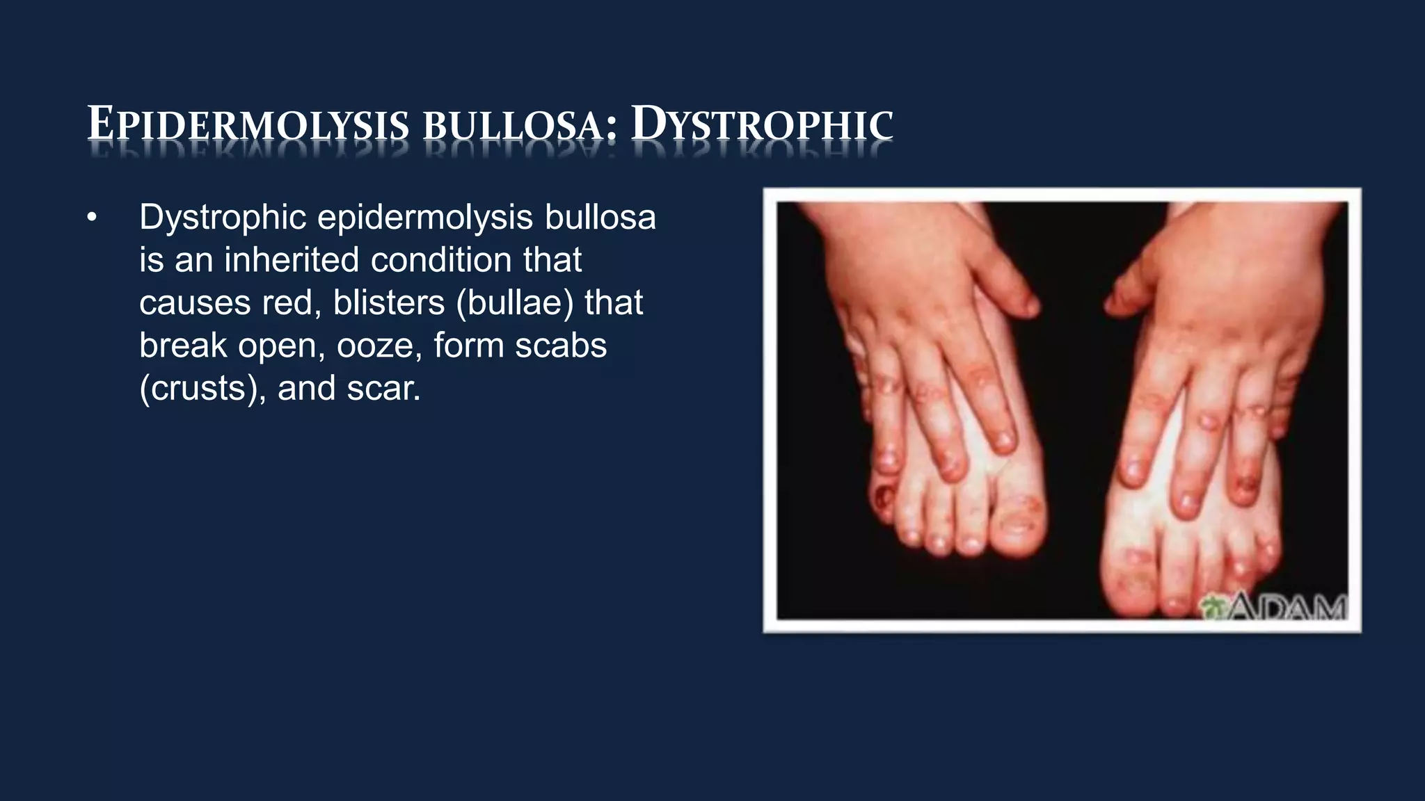 EPIDERMOLYSIS BULLOSA: DYSTROPHIC
• Dystrophic epidermolysis bullosa
is an inherited condition that
causes red, blisters (bullae) that
break open, ooze, form scabs
(crusts), and scar.
 