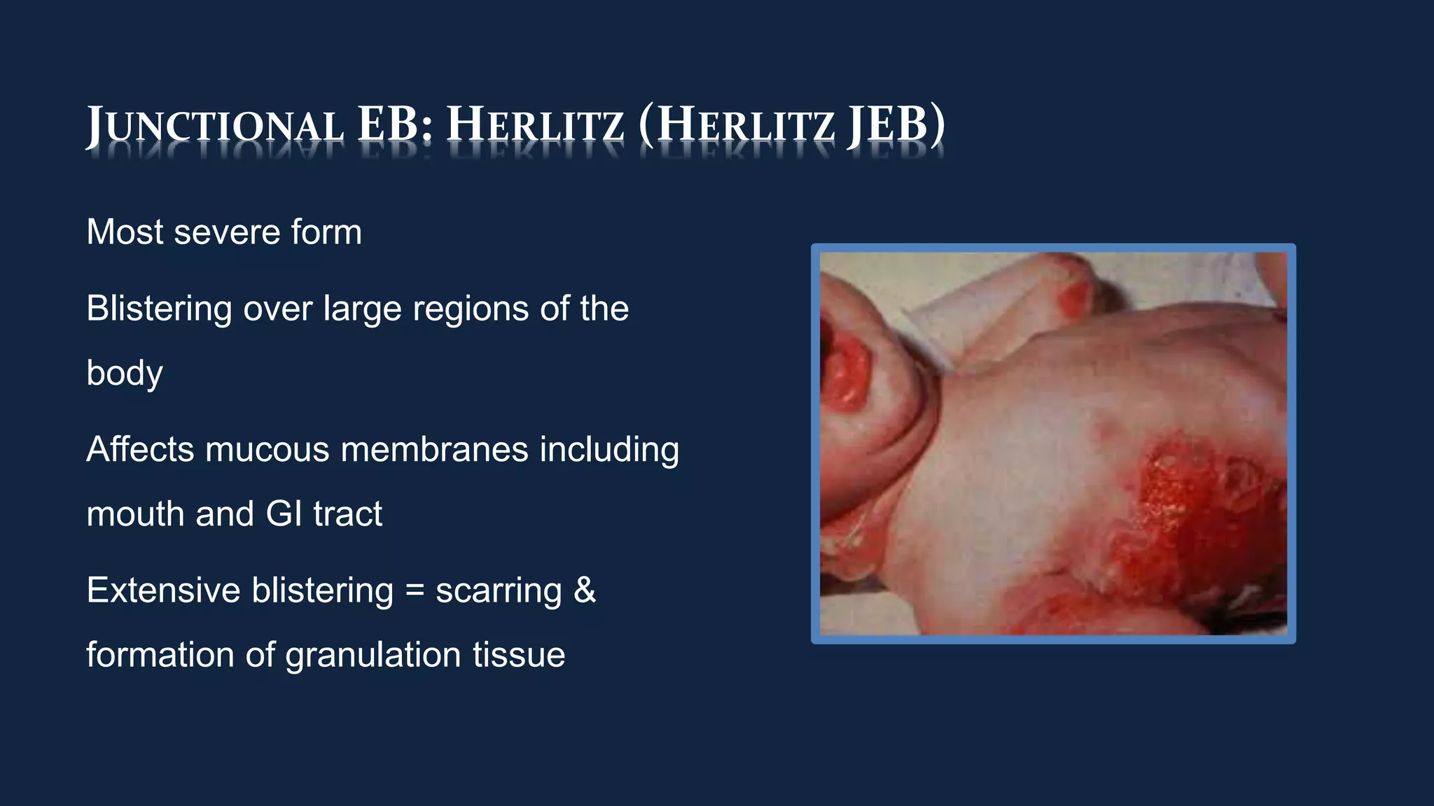 JUNCTIONAL EB: HERLITZ (HERLITZ JEB)
Most severe form
Blistering over large regions of the
body
Affects mucous membranes including
mouth and GI tract
Extensive blistering = scarring &
formation of granulation tissue
 