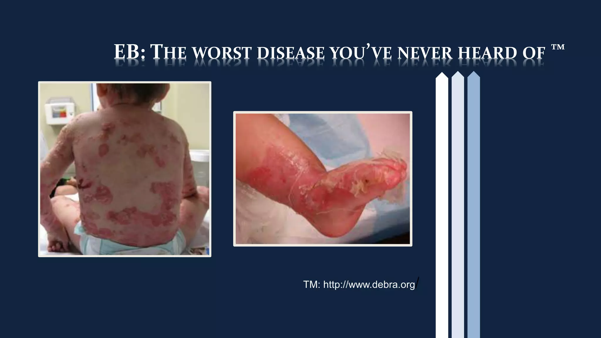 EB: THE WORST DISEASE YOU’VE NEVER HEARD OF ™
TM: http://www.debra.org/
 