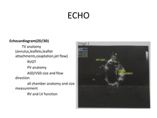 ECHO
Echocardiogram(2D/3D)
TV anatomy
(annulus,leaflets,leaflet
attachments,coaptation,jet flow)
RVOT
PV anatomy
ASD/VSD size and flow
direction
all chamber anatomy and size
measurement
RV and LV function
 