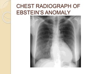 CHEST RADIOGRAPH OF
EBSTEIN’S ANOMALY
 