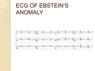ECG OF EBSTEIN’S
ANOMALY
 