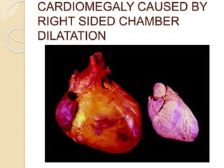 CARDIOMEGALY CAUSED BY
RIGHT SIDED CHAMBER
DILATATION
 