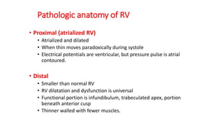 Pathologic anatomy of RV
• Proximal (atrialized RV)
• Atrialized and dilated
• When thin moves paradoxically during systole
• Electrical potentials are ventricular, but pressure pulse is atrial
contoured.
• Distal
• Smaller than normal RV
• RV dilatation and dysfunction is universal
• Functional portion is infundibulum, trabeculated apex, portion
beneath anterior cusp
• Thinner walled with fewer muscles.
 