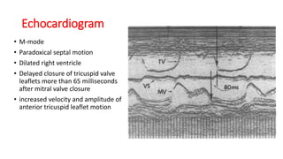 Echocardiogram
• M-mode
• Paradoxical septal motion
• Dilated right ventricle
• Delayed closure of tricuspid valve
leaflets more than 65 milliseconds
after mitral valve closure
• increased velocity and amplitude of
anterior tricuspid leaflet motion
 