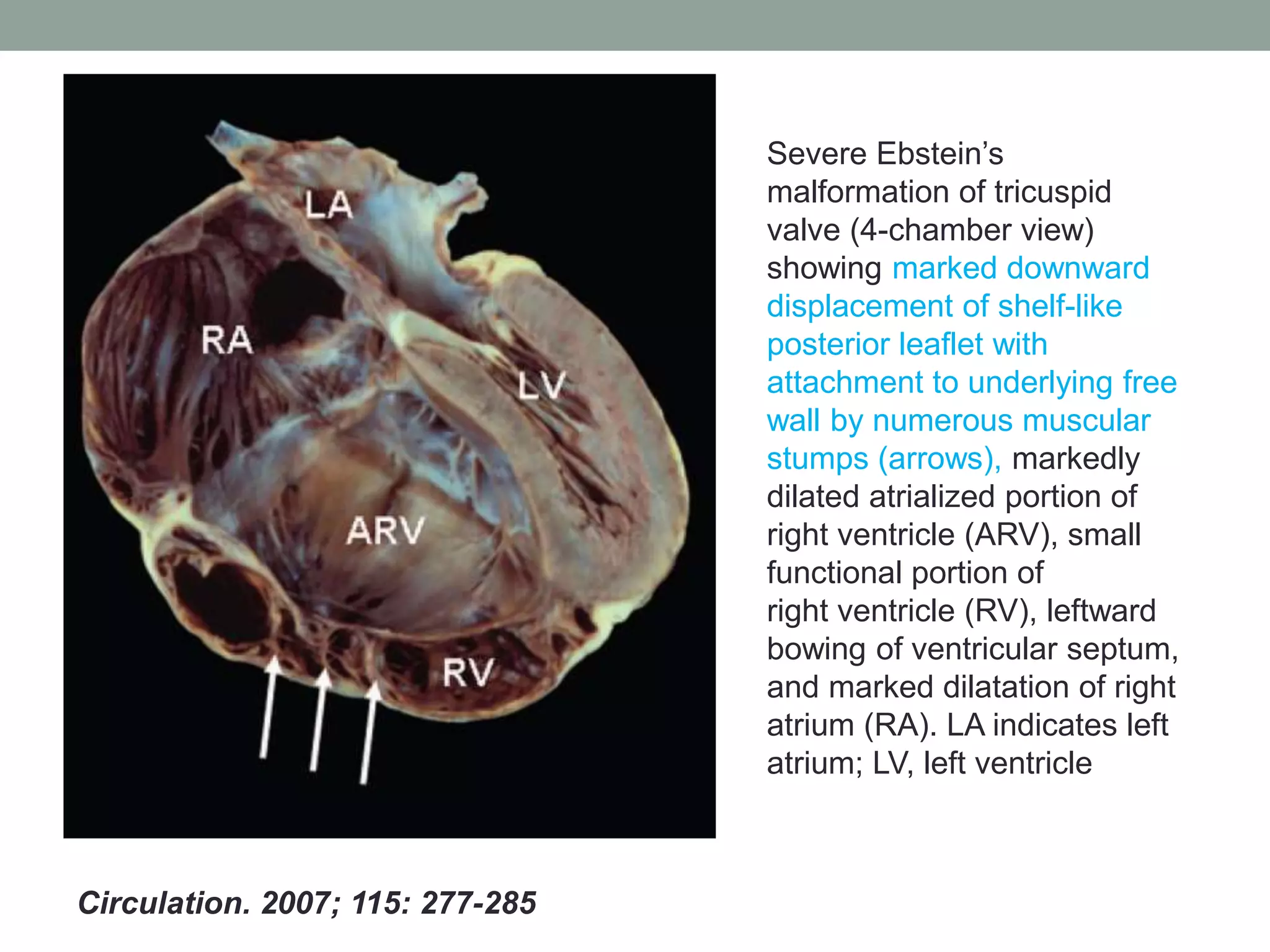 Ebstein anomaly | PPTX