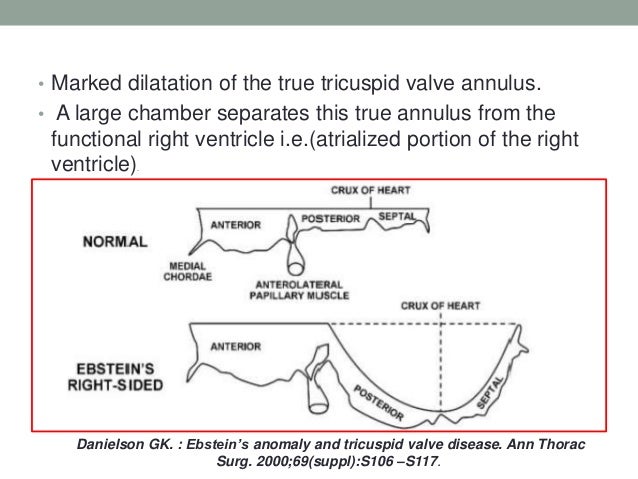 Ebstein anomaly