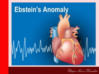 Ebstein's Anomaly
 