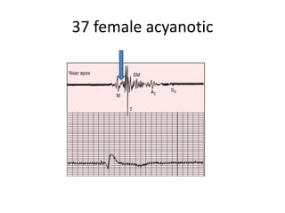 37 female acyanotic
 