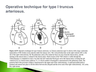 Truncus Methods Ebstein’s anomaly & Truncus Arteriosus | PPTX