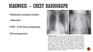 DIAGNOSIS – CHEST RADIOGRAPH
 Markedly enlarged cardiac
silhouette
 CTR > 0.65 (Poor prognosis)
 RA enlargement
 