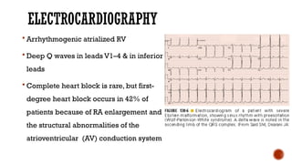 ELECTROCARDIOGRAPHY
 Arrhythmogenic atrialized RV
 Deep Q waves in leads V1–4 & in inferior
leads
 Complete heart block is rare, but first-
degree heart block occurs in 42% of
patients because of RA enlargement and
the structural abnormalities of the
atrioventricular (AV) conduction system
 