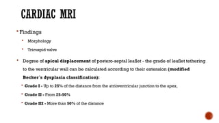 CARDIAC MRI
 Findings
 Morphology
 Tricuspid valve
 Degree of apical displacement of postero-septal leaflet - the grade of leaflet tethering
to the ventricular wall can be calculated according to their extension (modified
Becker´s dysplasia classification):
 Grade I - Up to 25% of the distance from the atrioventricular junction to the apex,
 Grade II - From 25-50%
 Grade III - More than 50% of the distance
 