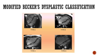 MODIFIED BECKER’S DYSPLASTIC CLASSIFICATION
 