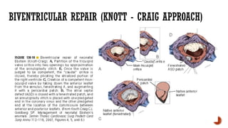 BIVENTRICULAR REPAIR (KNOTT - CRAIG APPROACH)
 